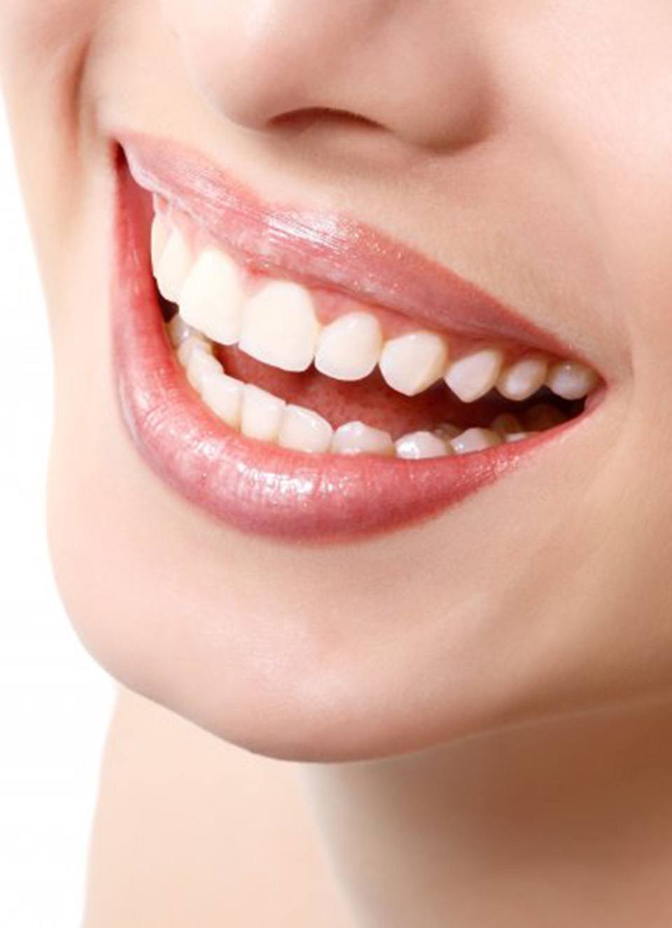 Close up of a smile filled by a dental bridge