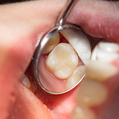 Woman getting a dental filling