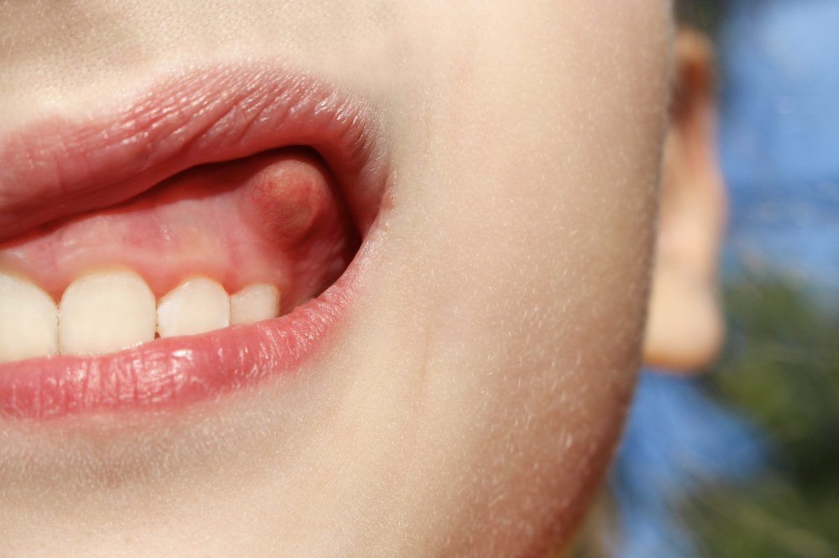 Bump on Your Gums in Jacksonville? | Jacksonville Dental Excellence